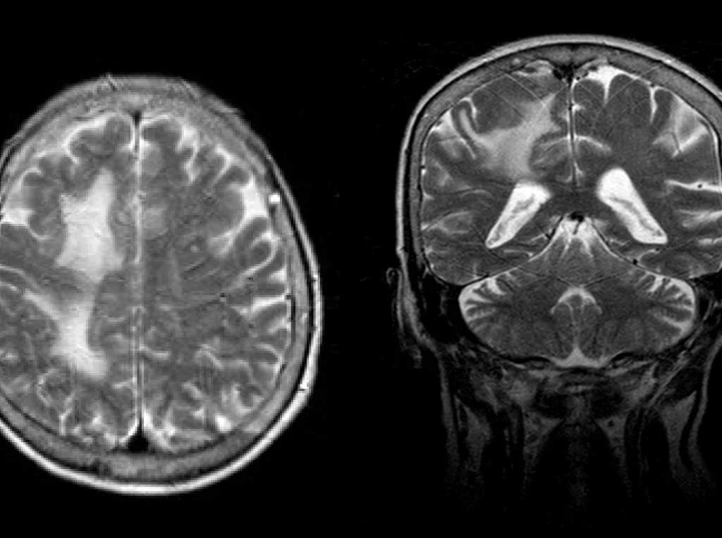 Brain MRI Dataset