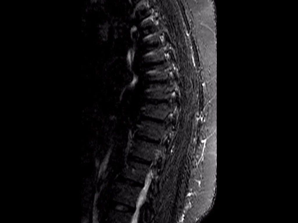 Spine MRI Dataset