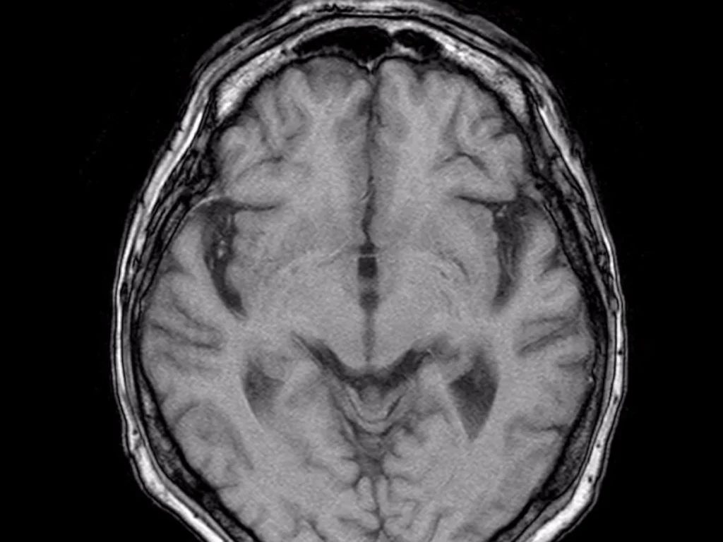Brain MRI Dataset