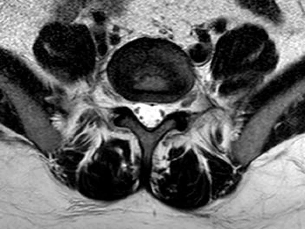 Spine MRI Dataset