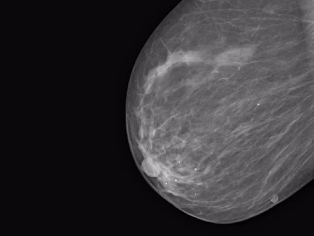Mammography Segmentation Dataset