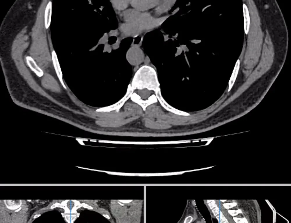CT Scan Chest Dataset