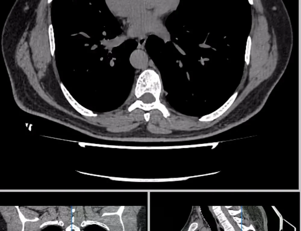 CT Scan Chest Dataset
