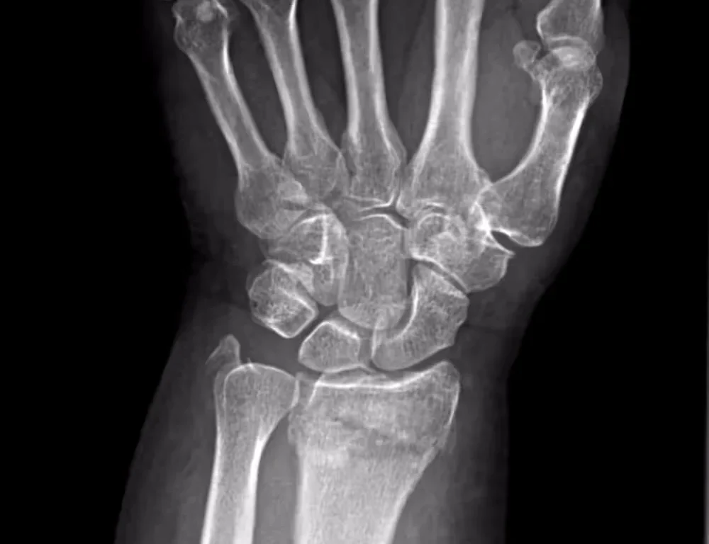 X-ray of upper-extremity joints