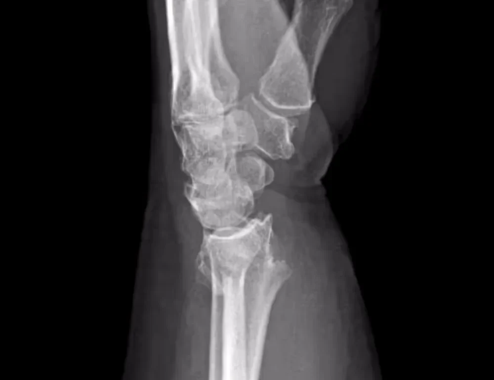 X-ray of upper-extremity joints
