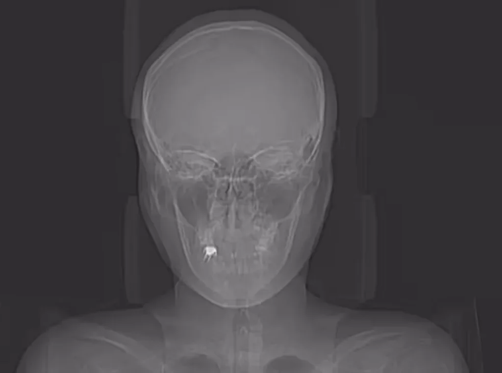 CT Scans of Brain
