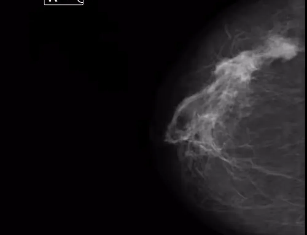 Mammography Dataset