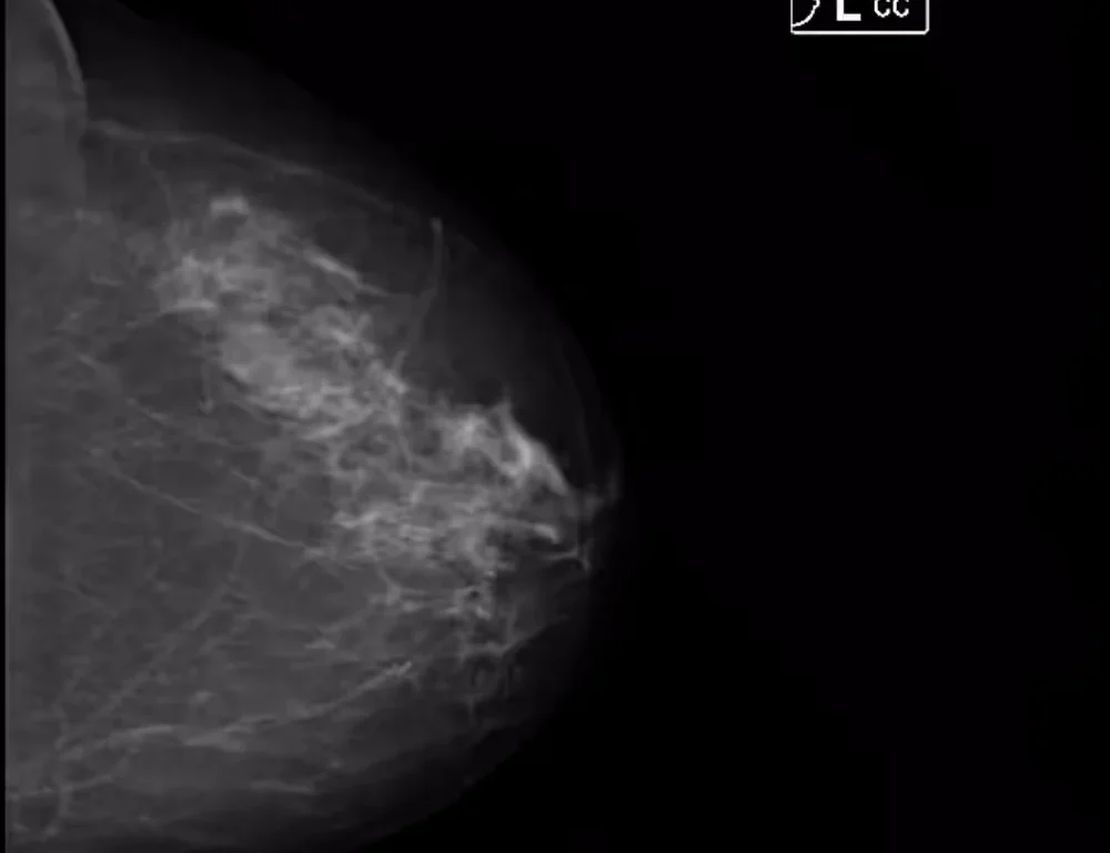 Mammography Dataset