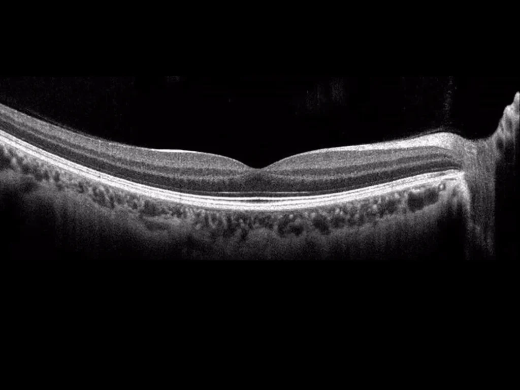 OCT Retinal Dataset