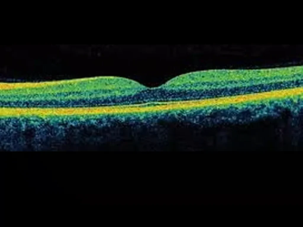 OCT Retinal Dataset