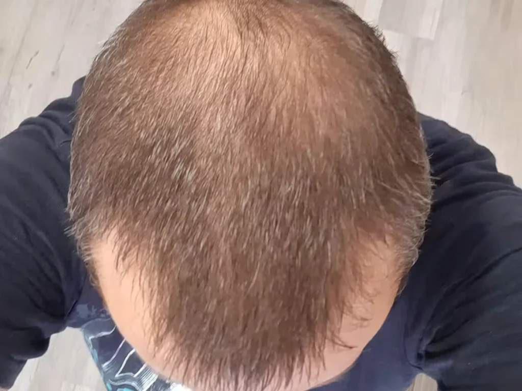 Male Hair Loss Dataset