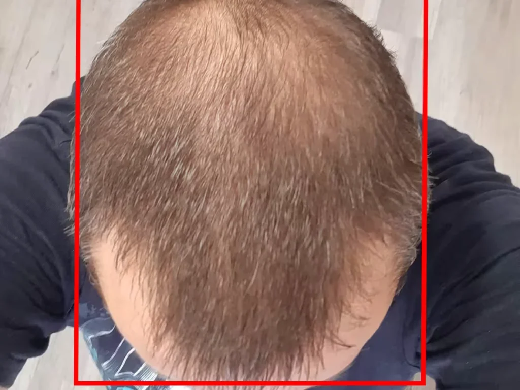 Male Hair Loss Dataset