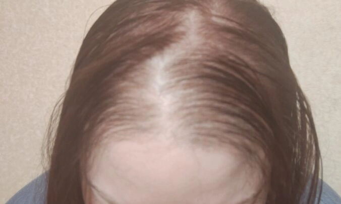 female hair loss dataset