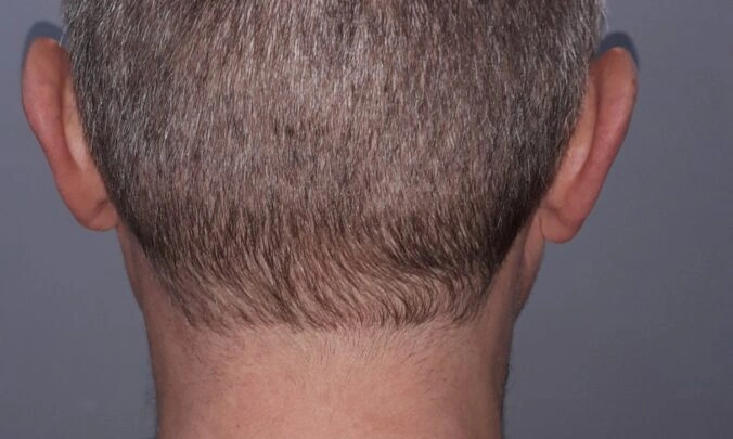 Male Hair Loss Dataset