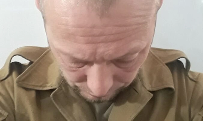 Male Hair Loss Dataset