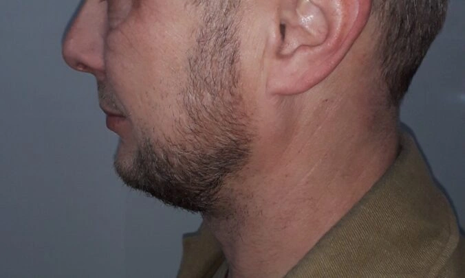 Male Hair Loss Dataset