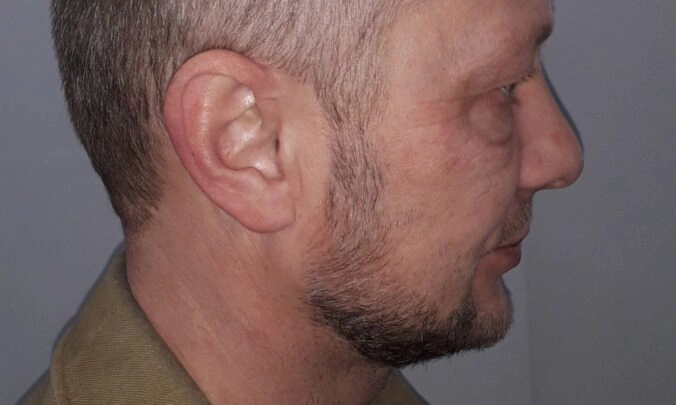 Male Hair Loss Dataset