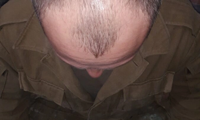 Male Hair Loss Dataset