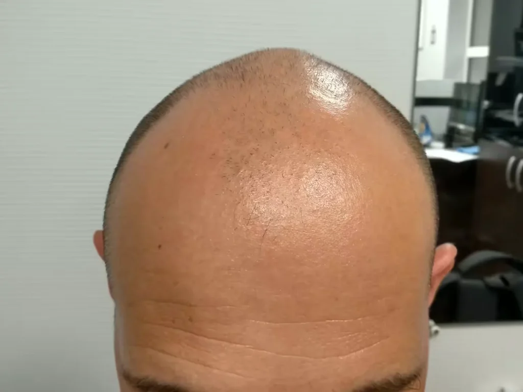 Men Hair Loss Segmentation Dataset