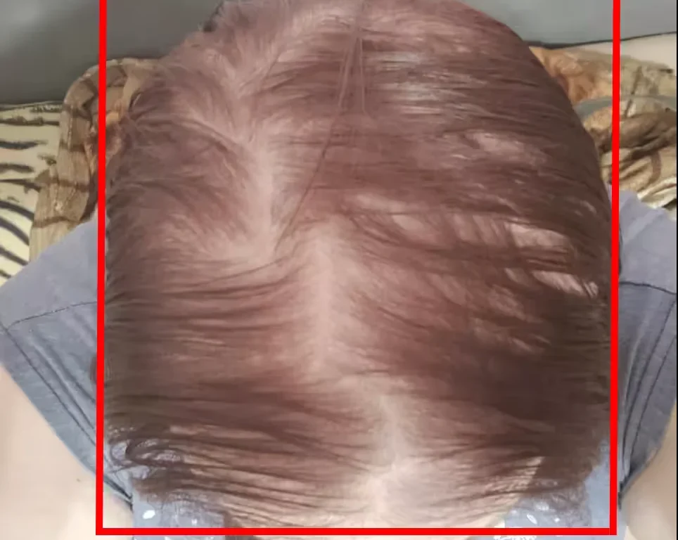 Female Hair Loss Dataset