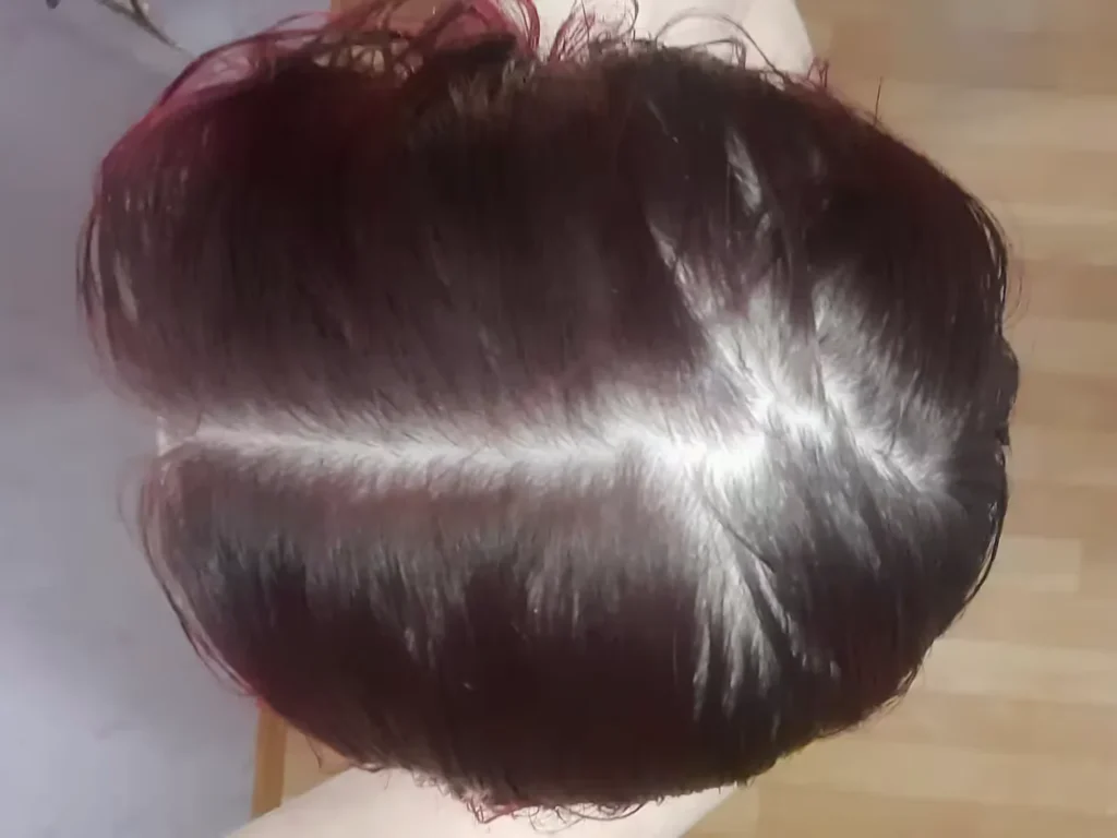Women Hair Loss Segmentation Dataset