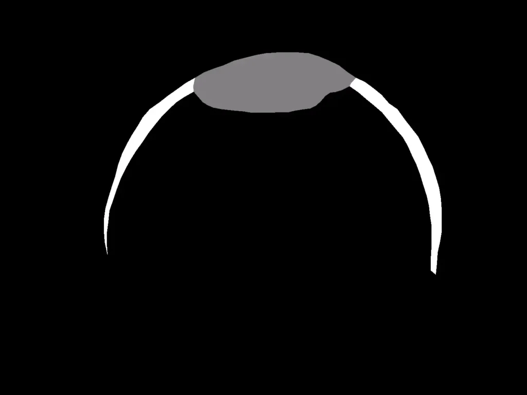 Men Hair Loss Segmentation Dataset