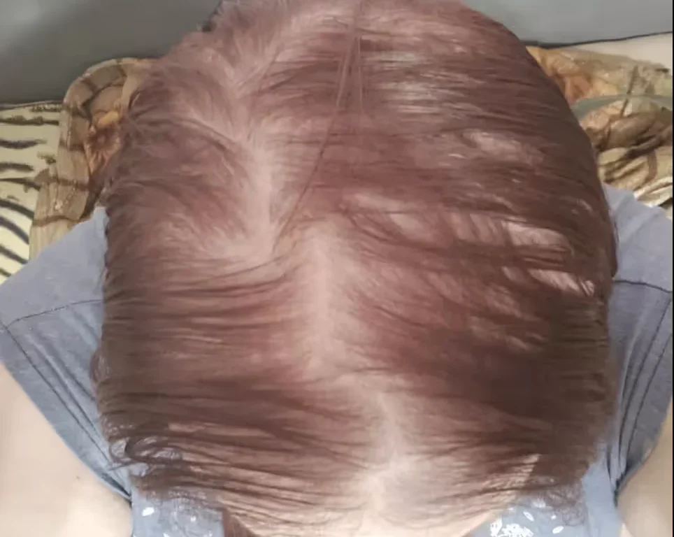 Female Hair Loss Dataset