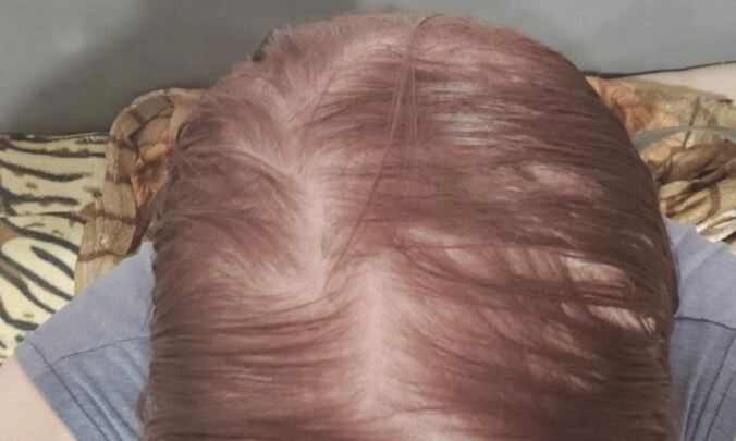 female hair loss dataset